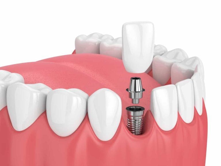 graphic of what a dental implant looks like