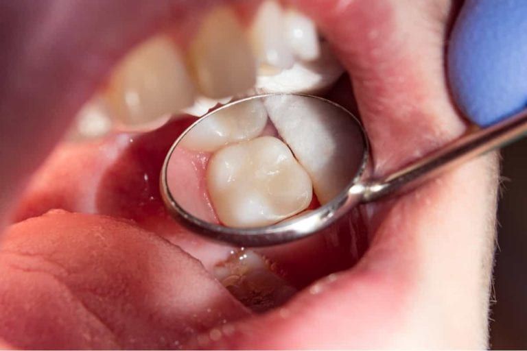 photo of teeth being seen through a dental mirror