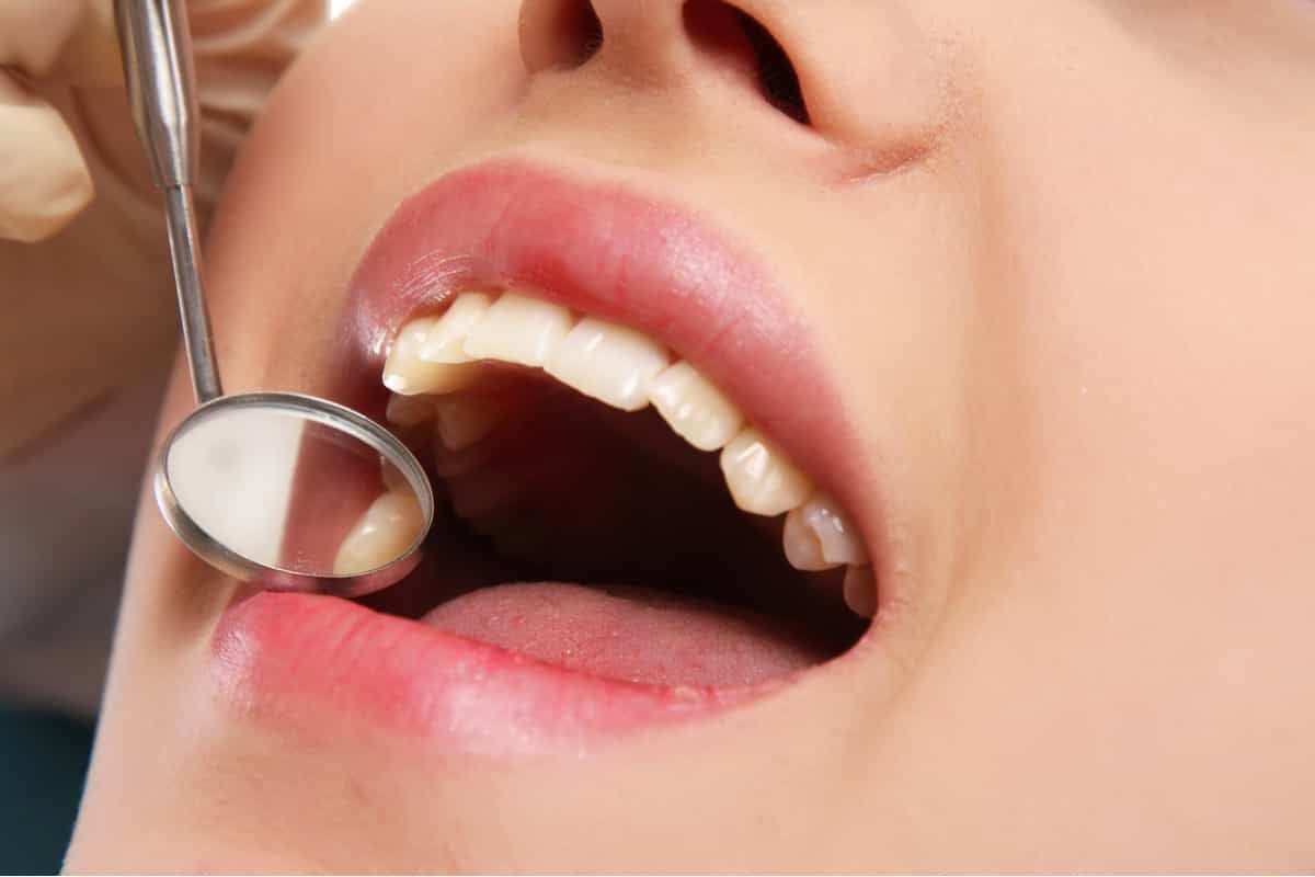 Women with her mouth open with dental mirror to check her teeth