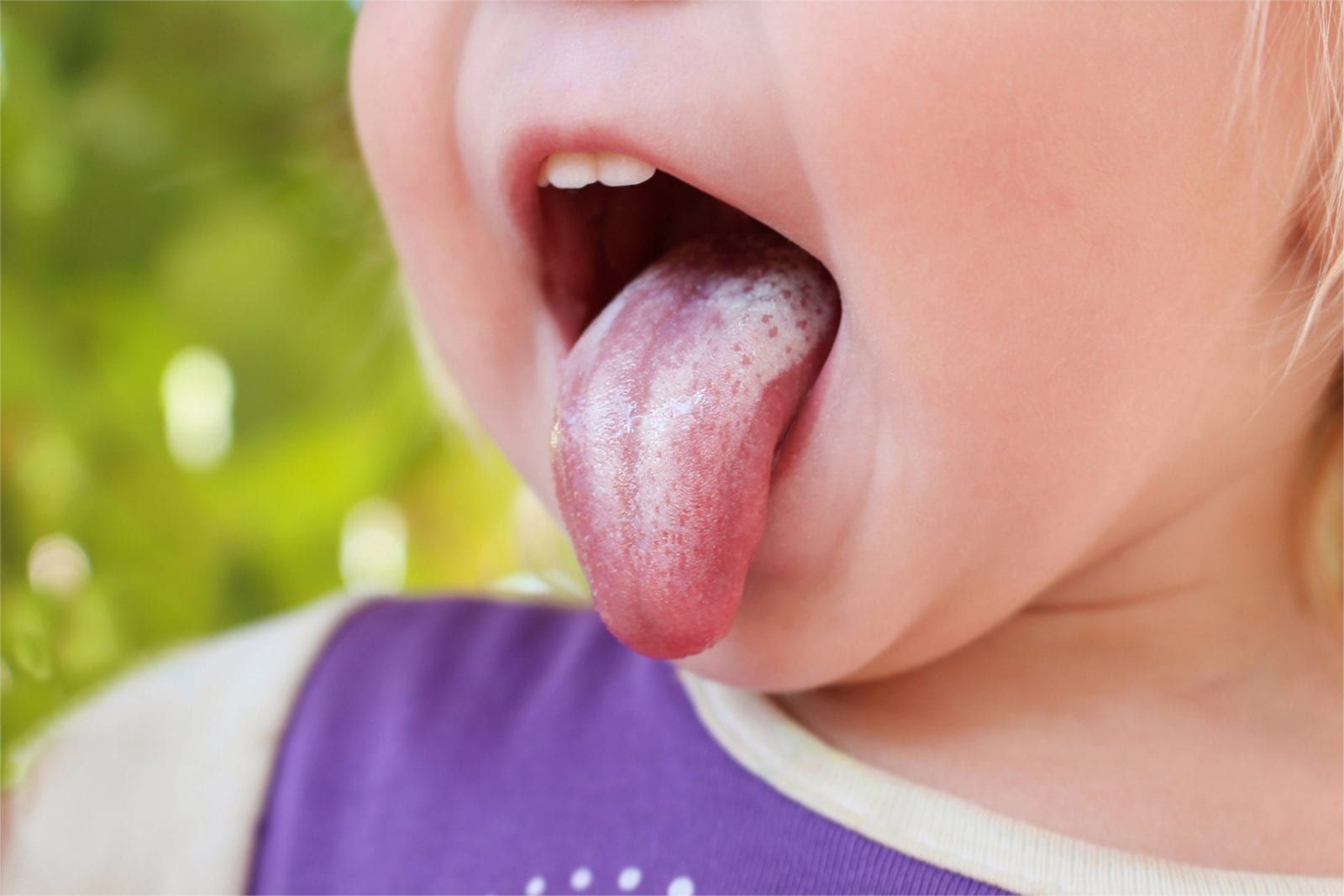 kid sticking their tongue out with oral thrush