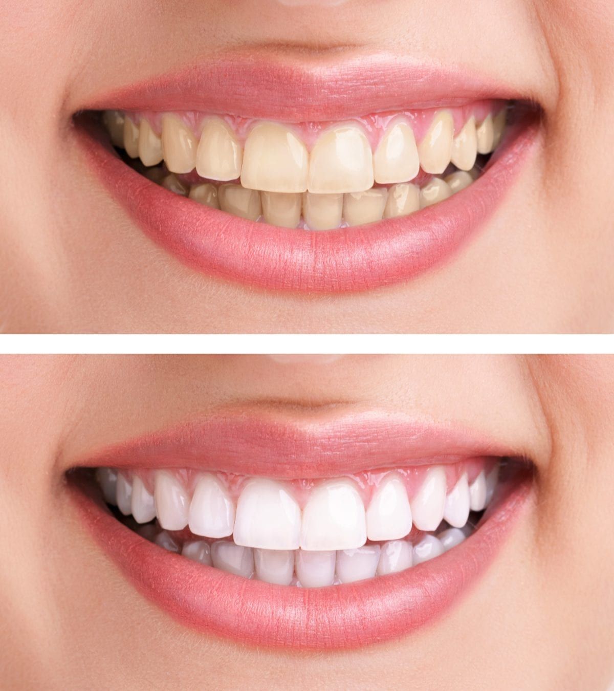 The Top 5 Cosmetic Dental Treatments Covington Dental