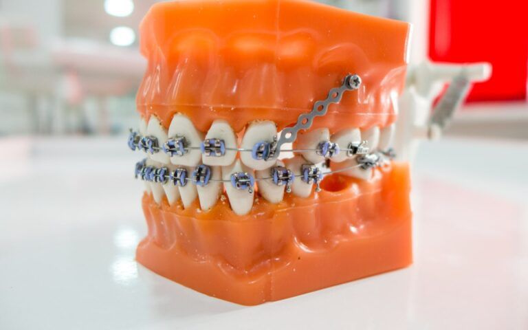 orthodontic anchorage model