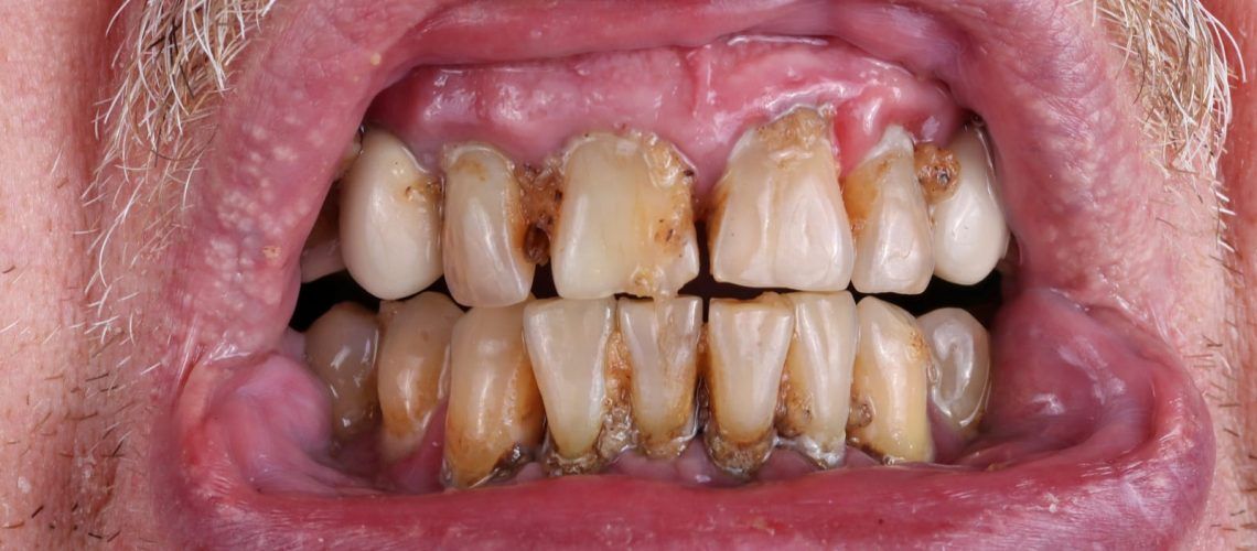 Mouth with periodontal disease