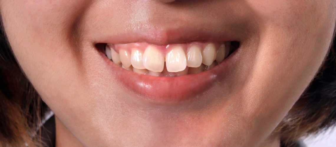 Woman with protruding teeth